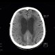 Leukoaraiosis, atherosclerotic encephalopathy, periventricular atrophy, hydrocephalus e vacuo: CT - Computed tomography